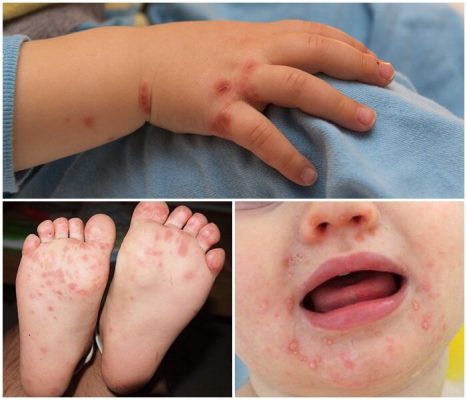 3 dấu hiệu cảnh báo bệnh tay chân miệng ở trẻ nhỏ chuyển nặng